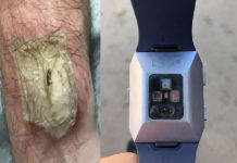 Fitbit smart fitness band explode caught fire on wrist google