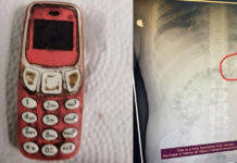 33 साल के आदमी ने निगला NOKIA 3310 फोन, 4 दिन तक पेट में पड़ा रहा! man-swallows-whole-nokia-3310-phone-endoscope-procedure-took-out-from-stomach